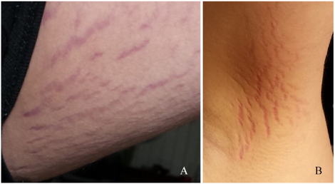 The “stretch mark” lesions that finally unraveled the boy’s mystery ailment, photographed in February 2017.